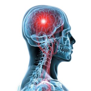 Neurocirugía